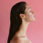 adult acne