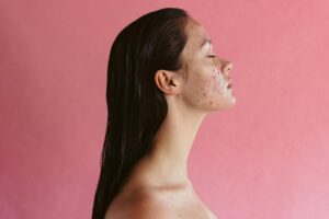 adult acne