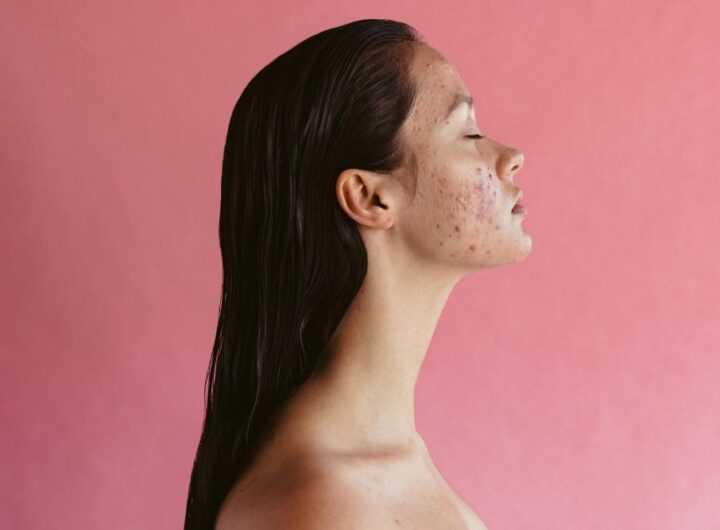 adult acne
